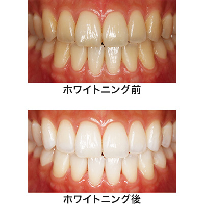 ホワイトニング | 小樽市若松の歯医者 佐藤歯科